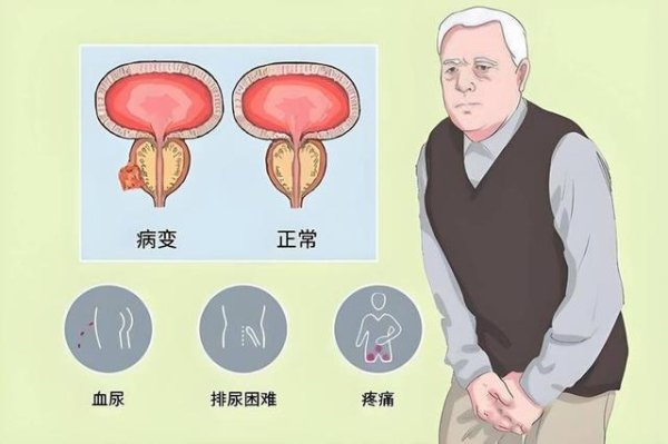 股票新闻 医生：前列腺癌最危险信号，不是尿频，而是频繁出现这几种异常